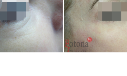 Фотона Глаза 2